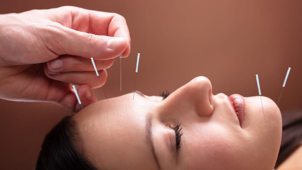 What are Benefits of Acupuncture for Neurological Conditions?