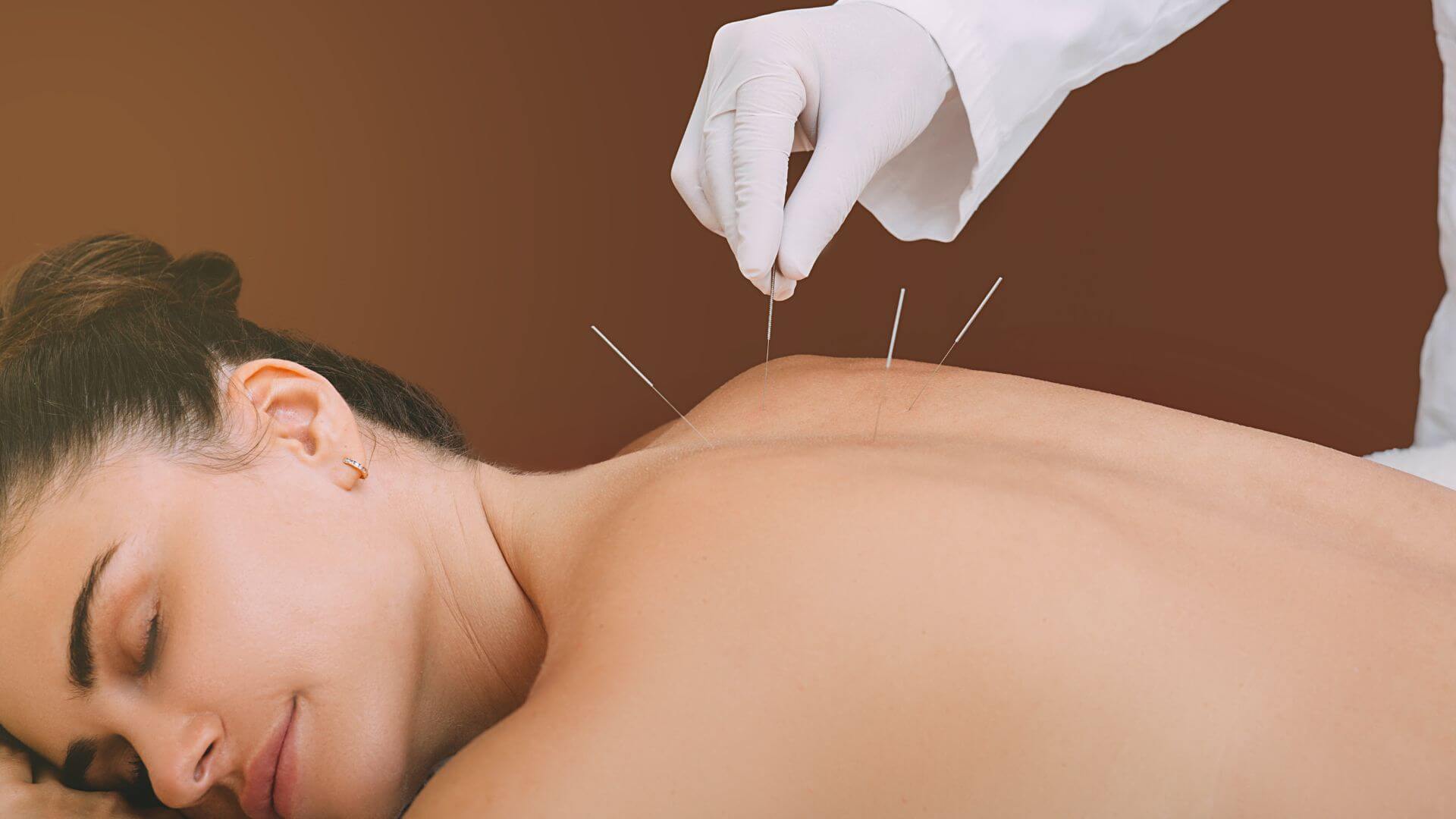 Acupuncture Treatment