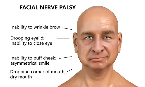 Bell’s Palsy (facial nerve paralysis)