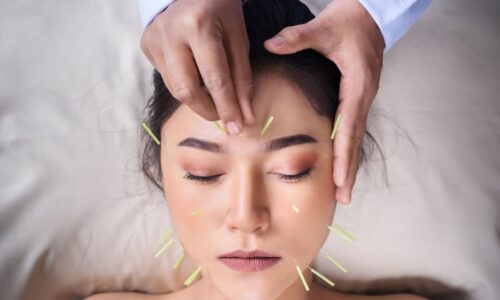 Cosmetic Acupuncture