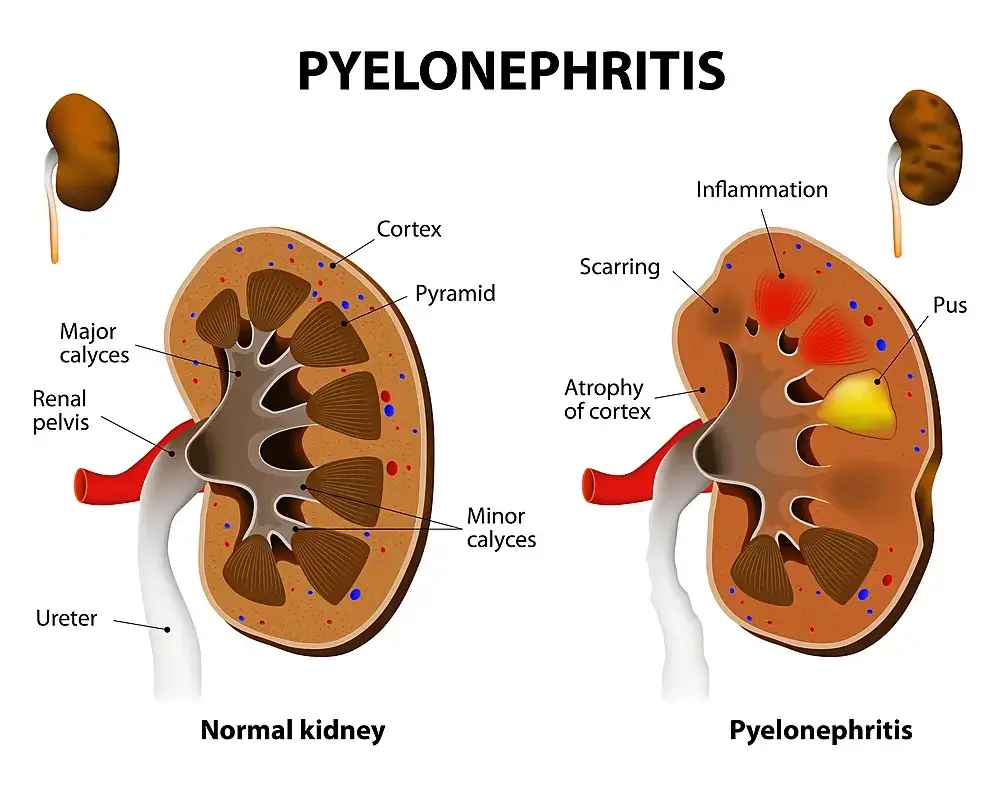 Naturopathic Insights into Pyelonephritis