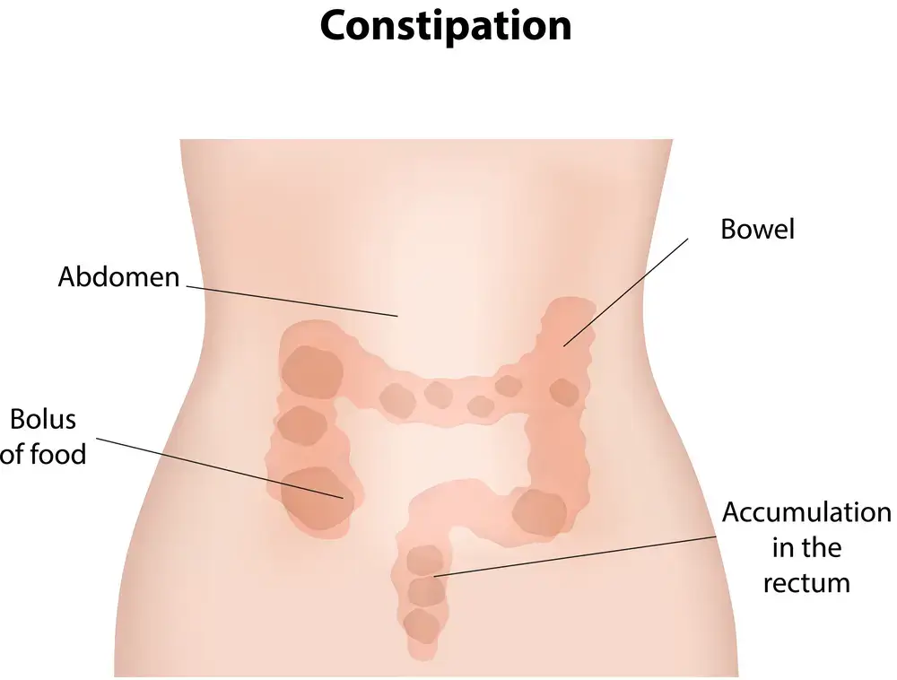 Acupuncture for Constipation