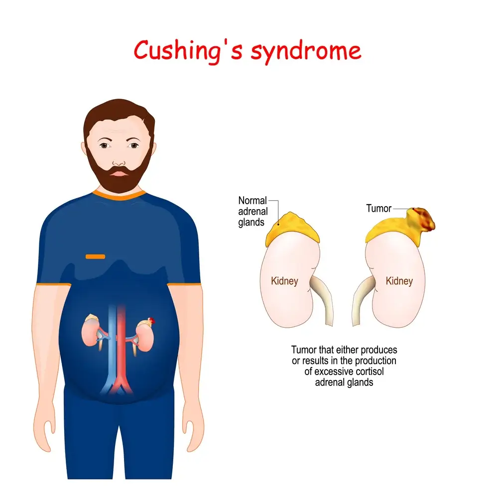 Read more about the article Cushing Syndrome (High Cortisol)