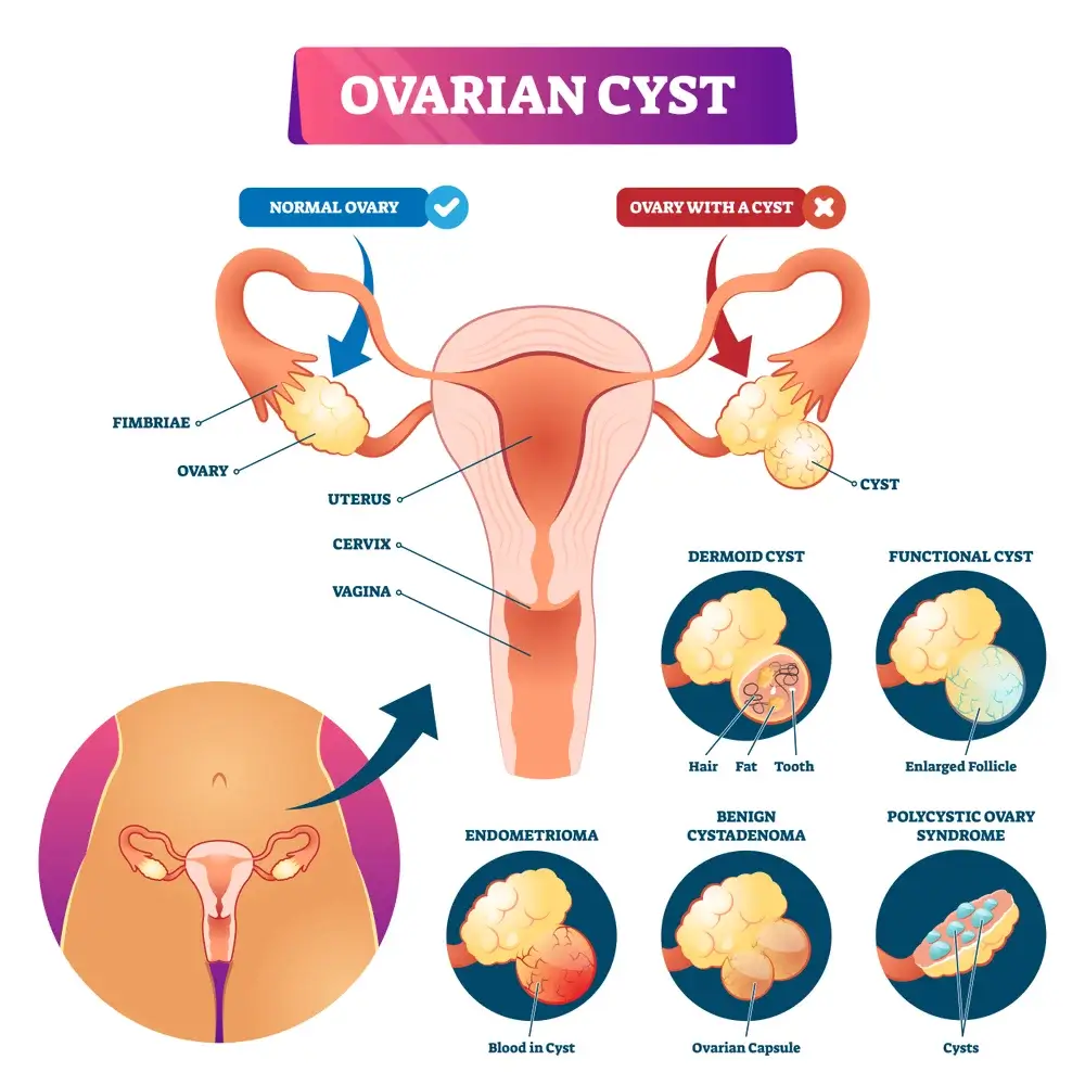 Ovarian Cyst