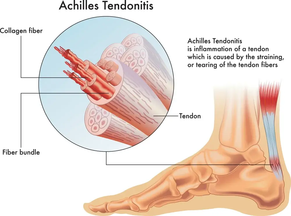 Naturopathic Perspectives on Tendonitis