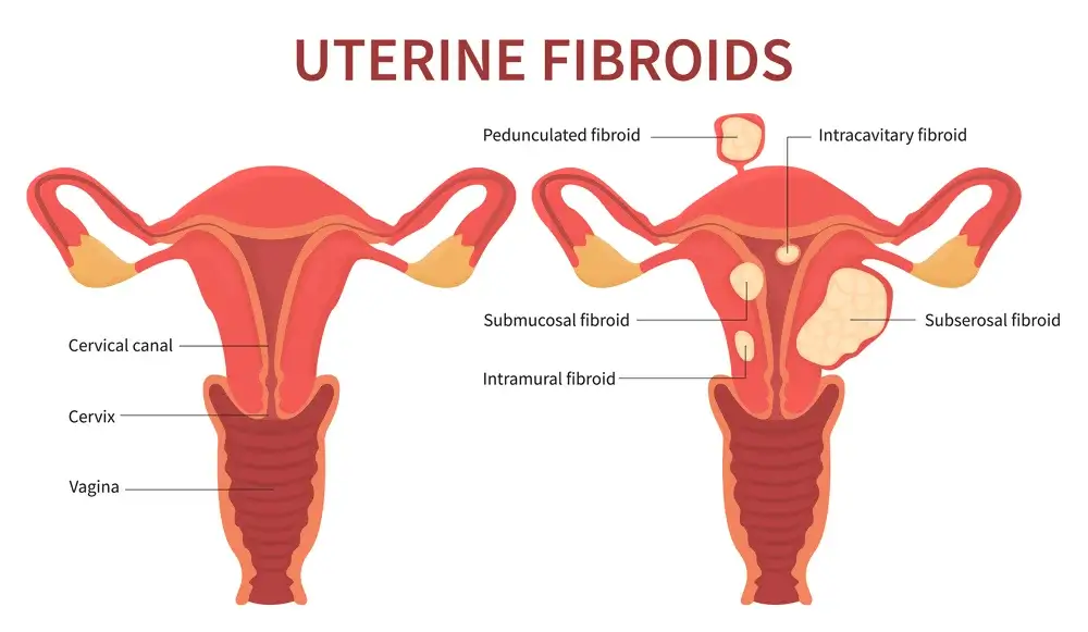 Symptoms of Uterine Fibroids