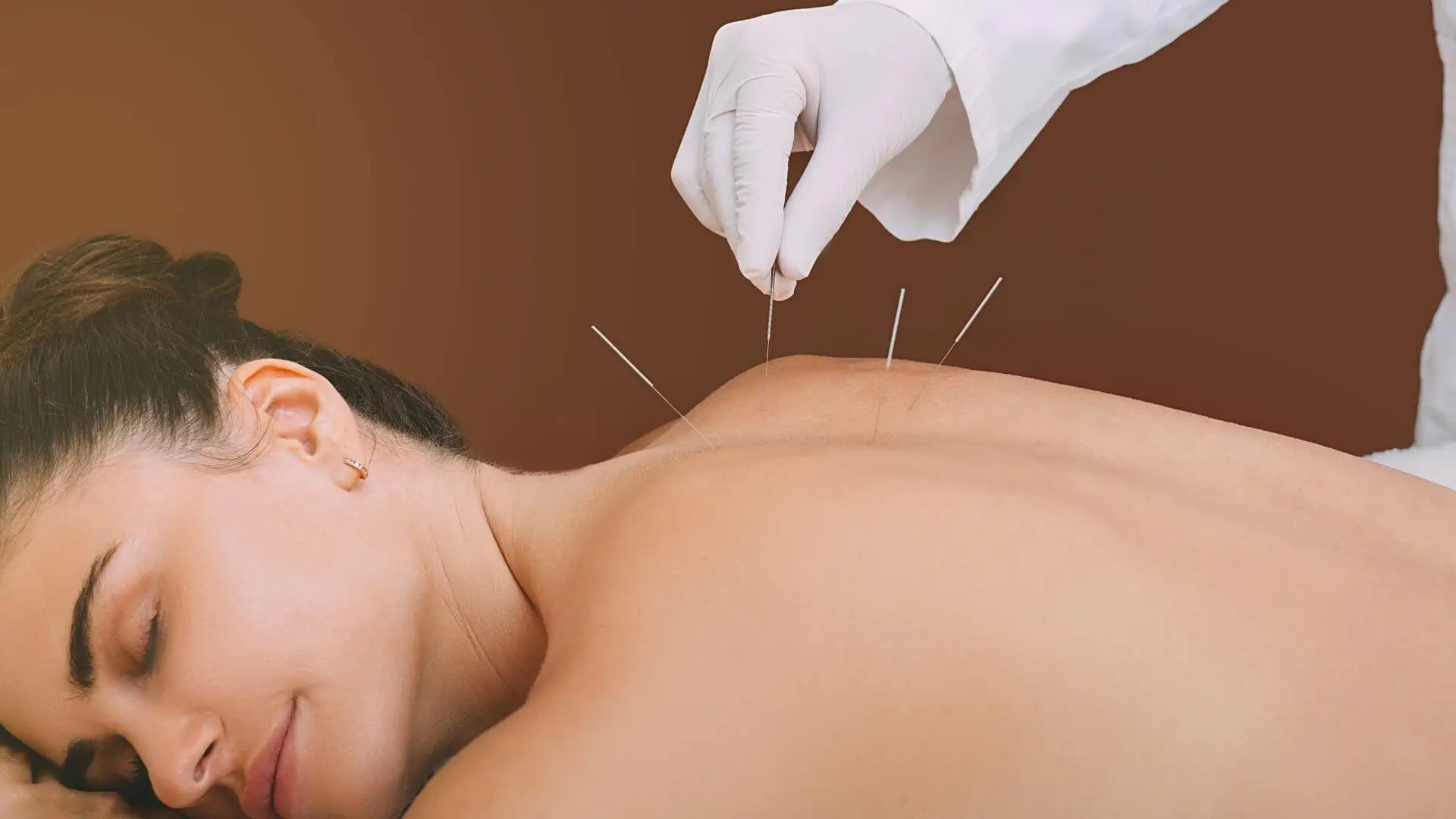 Acupuncture Treatment - #acupuncture