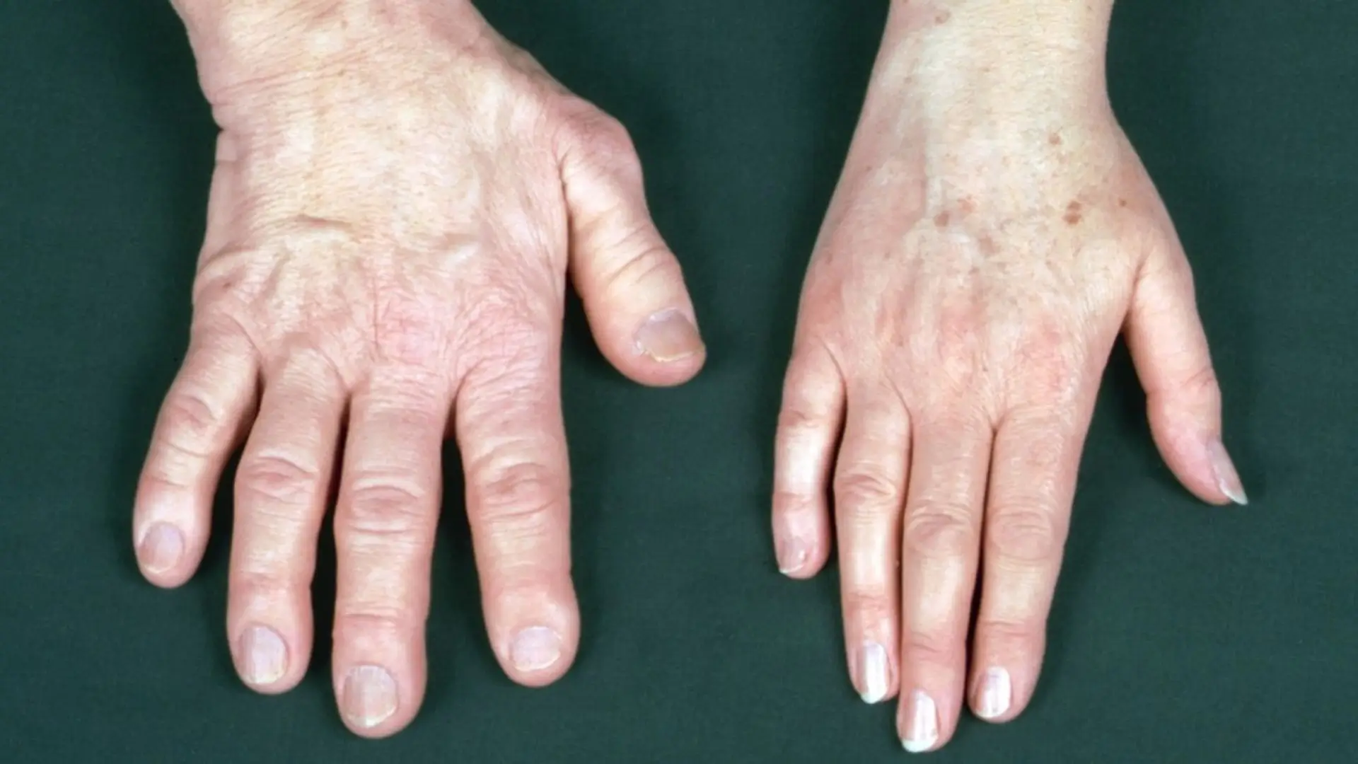 Read more about the article Acromegaly Treatment