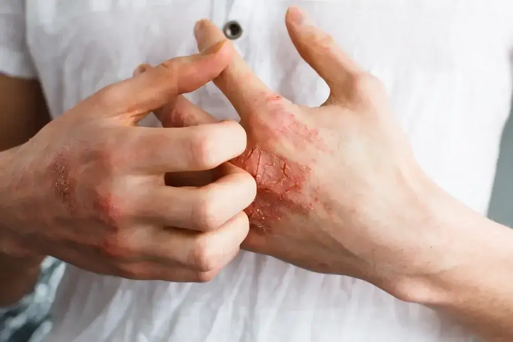 Naturopath for Dermatitis