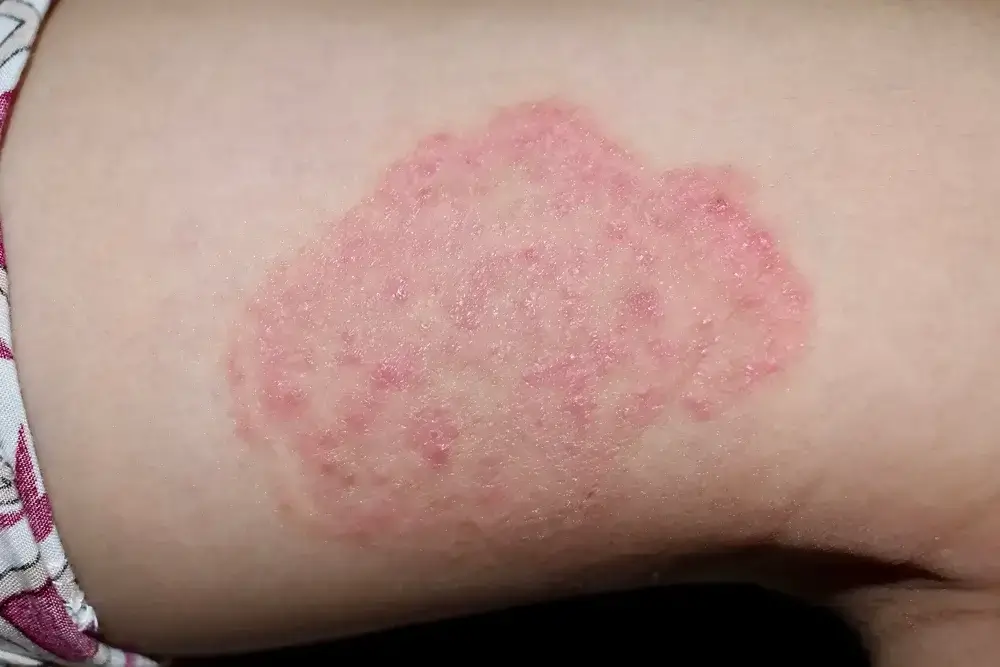 Naturopath for Fungal Infections