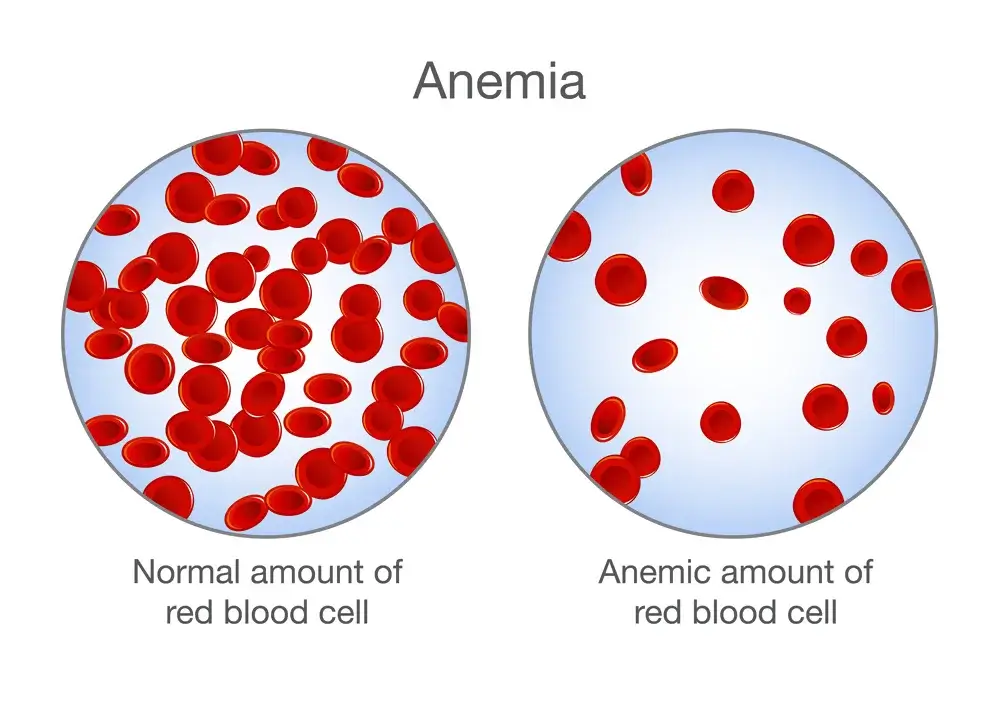 Anemia Treatment by Naturopathic Perspective