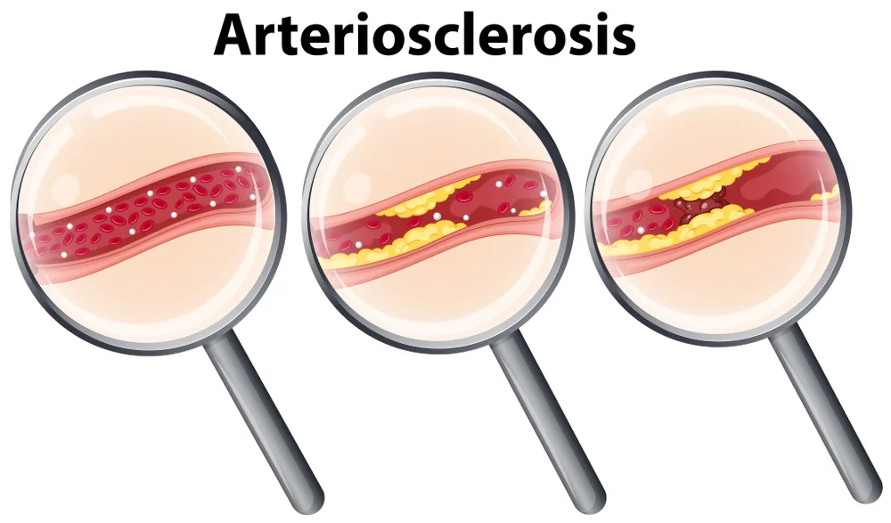 Approaches to Treating Arteriosclerosis from a Naturopathic Perspective