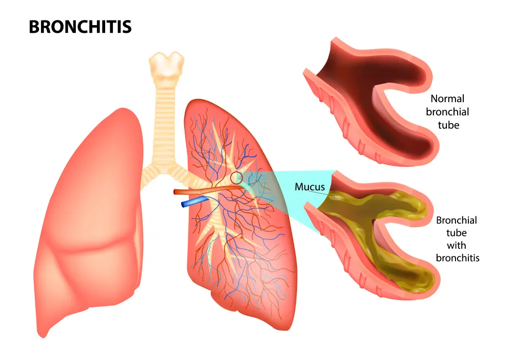 Bronchitis