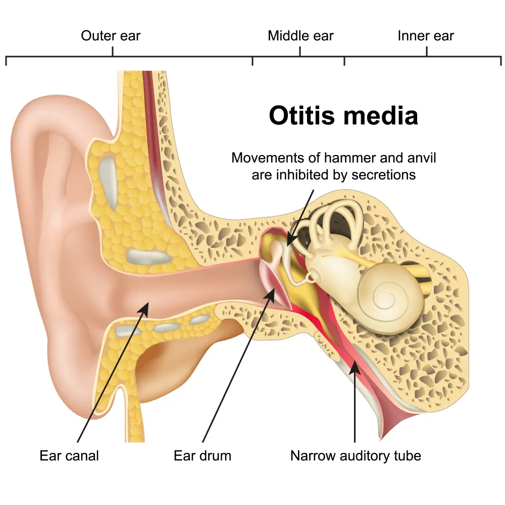 Osteopathic Interventions for Pediatric Otitis Media (OM) in Babies and Children