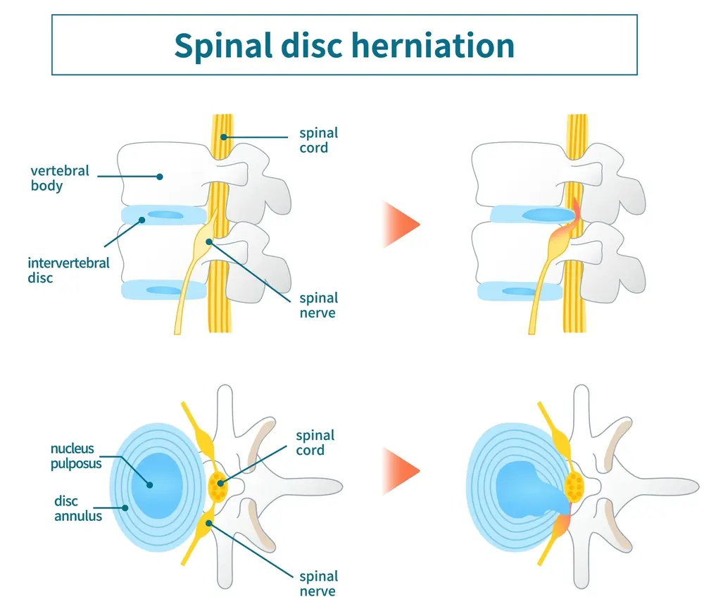 Cervical Herniated Disc