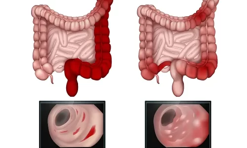 Naturopathic Approaches to Inflammatory Bowel Disease (IBD) – Crohn’s Disease and Ulcerative Colitis