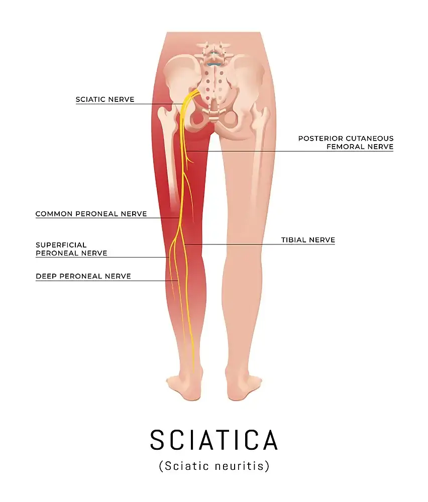 Naturopathic Considerations for Sciatica