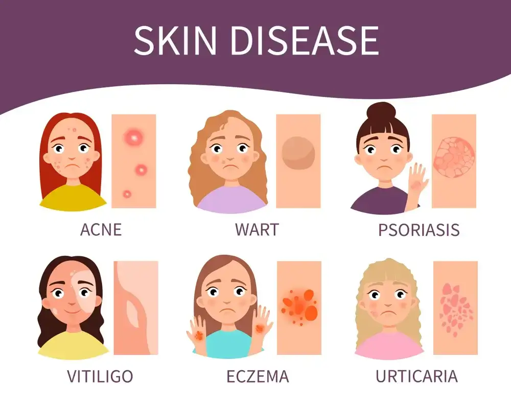 Skin Disease such as Acne and Eczema