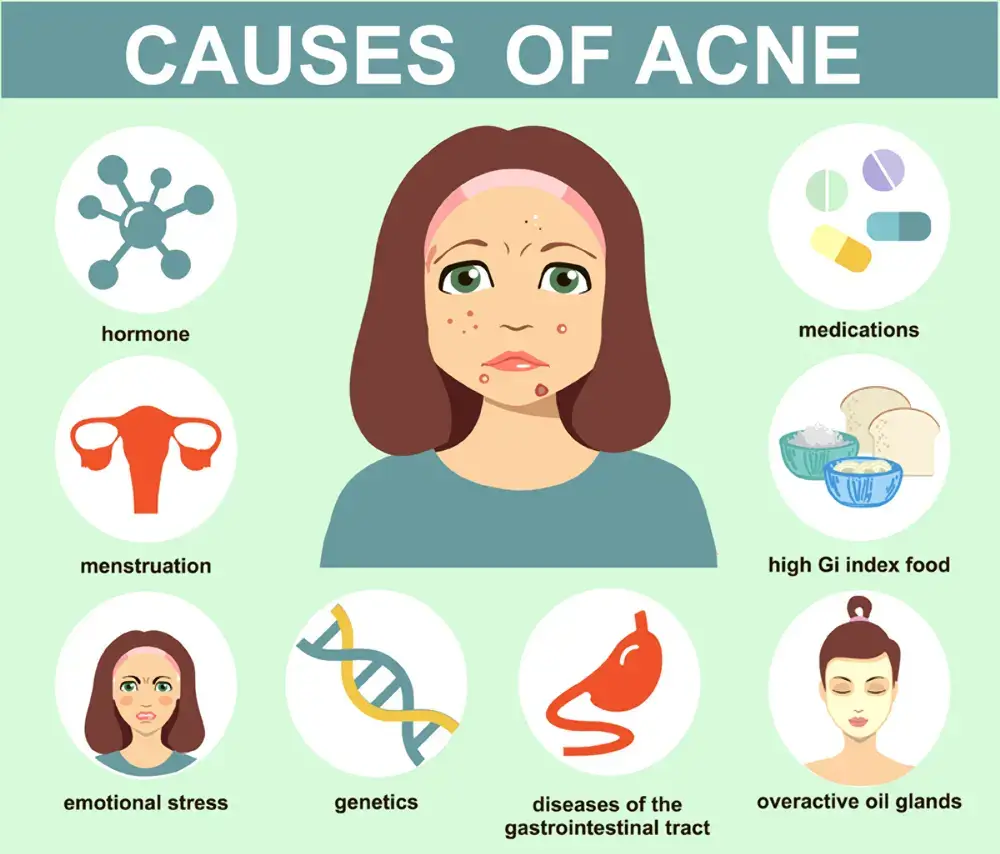 Causes of Acne