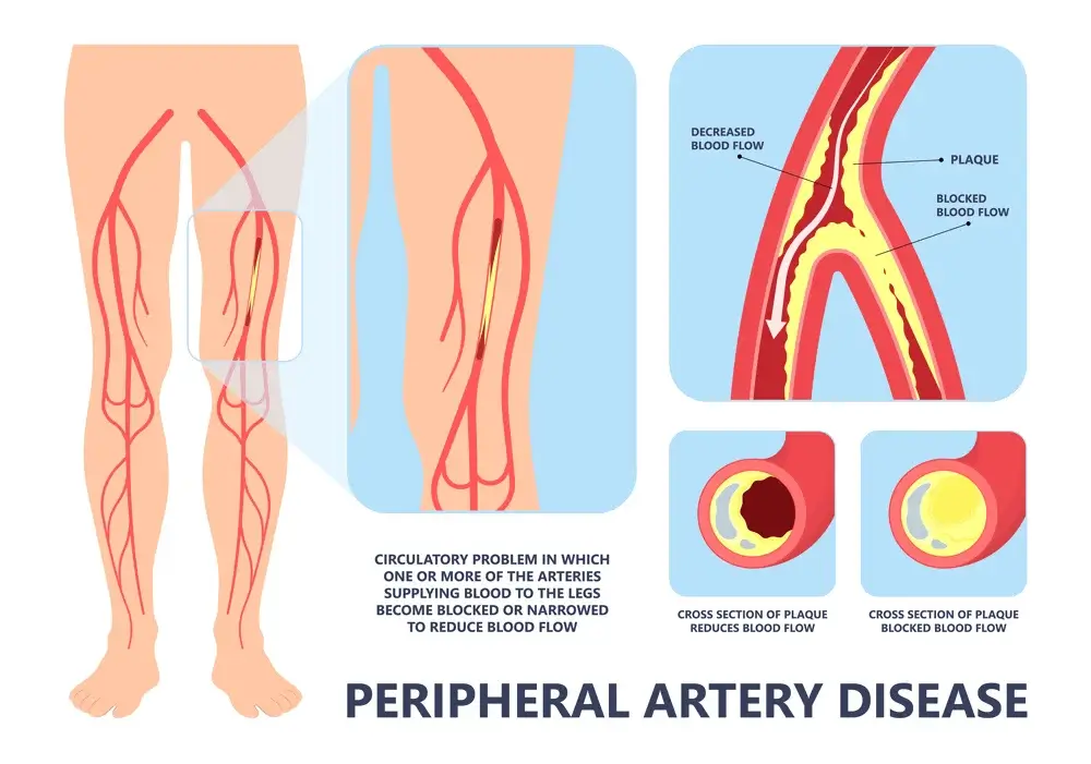 Read more about the article Peripheral Vascular Disease (PVD)