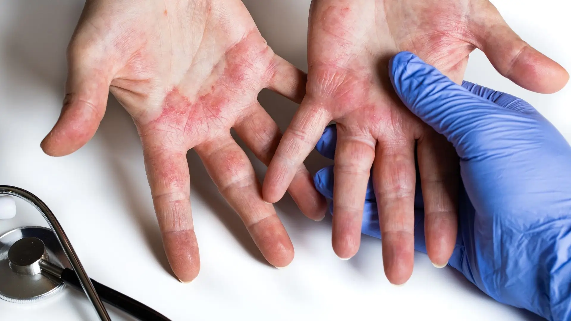 Dermatitis, Skin Allergies, and Eczema Treatment