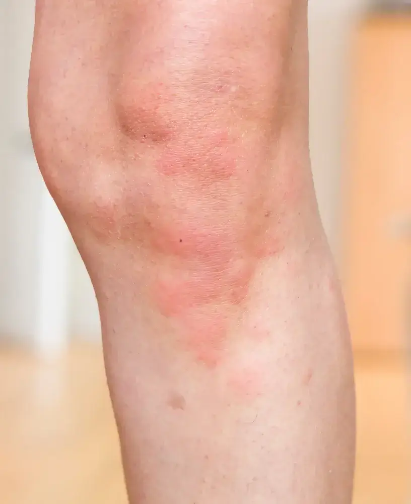 Naturopath for Hives