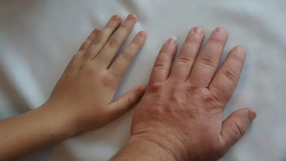 Naturopath for Acromegaly