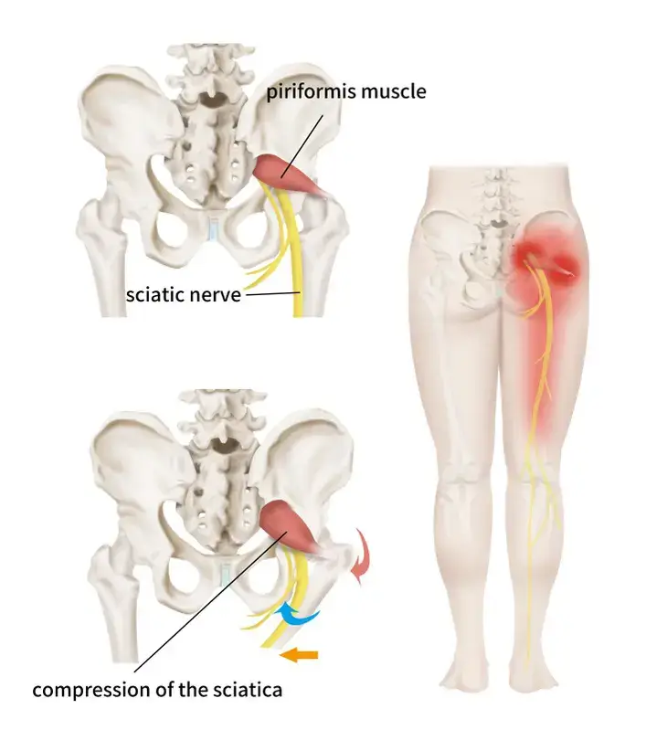 Sciatica Complications