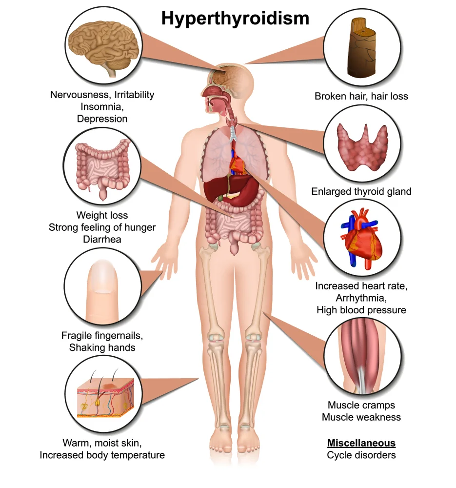Thyroid issues Hyperthyroidism 1