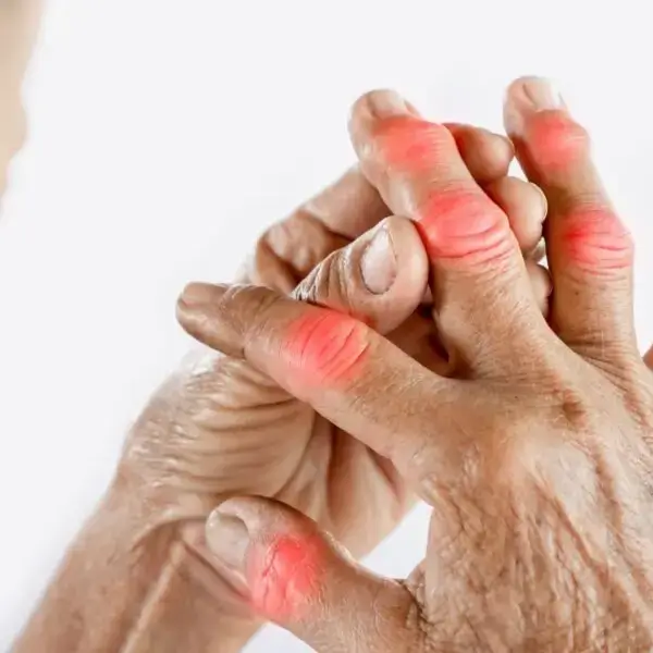 Arthritis / Arthralgia (joint pain), Pain Management