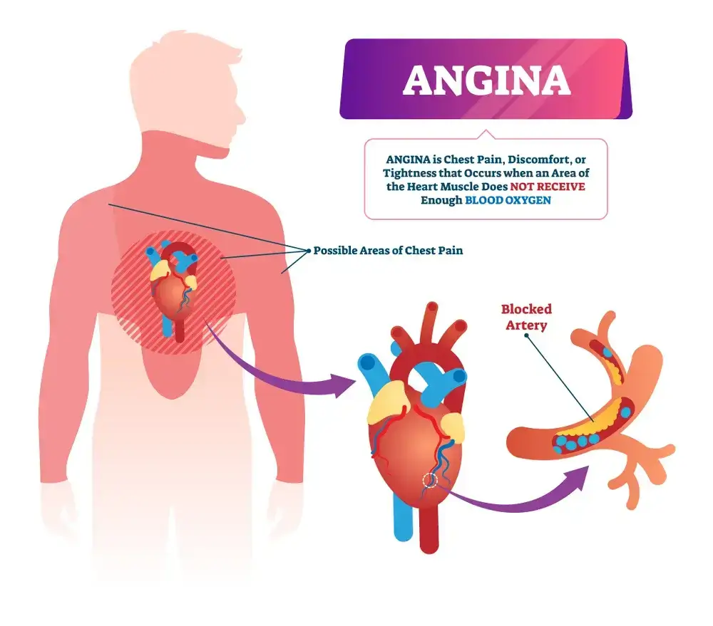 Factors Contributing to Angina #angina @angina