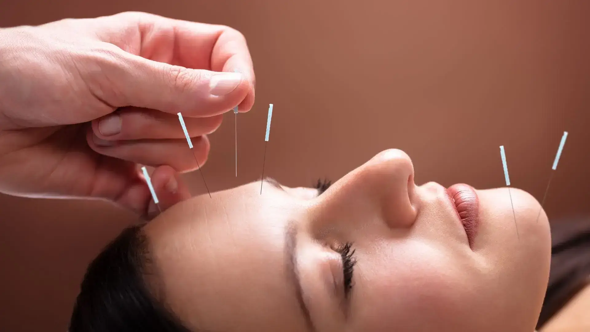 Choosing Acupuncture at Naturopath Osteopath Clinic