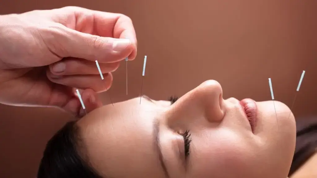 Acupuncture for Neurological Conditions