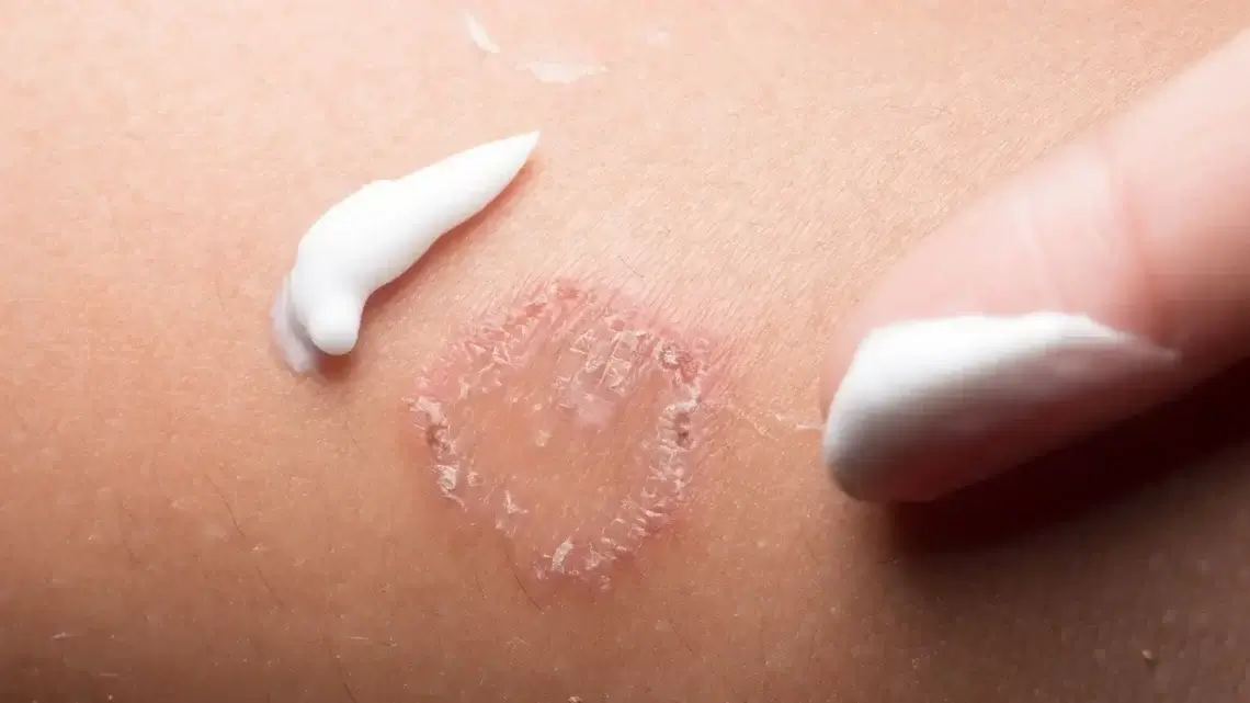 Fungal Infections – Tinea (ringworm)