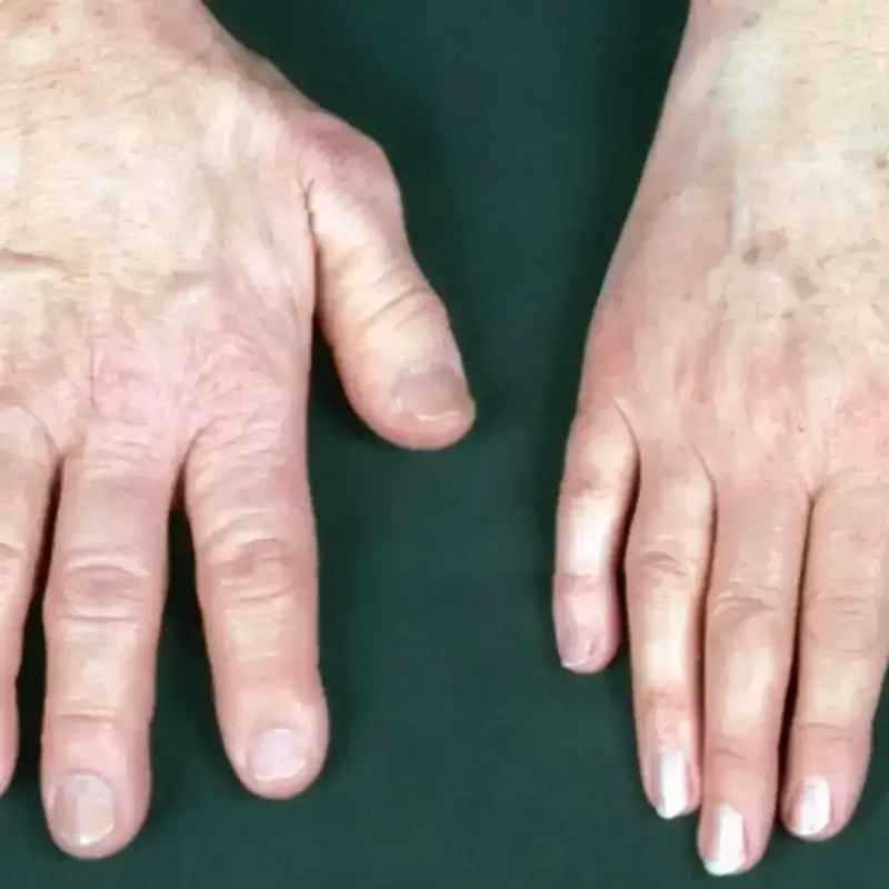 Acromegaly