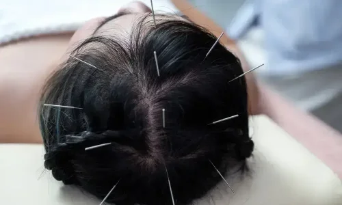 Benefits-of-Acupuncture-Care-for-Neurological-symptoms