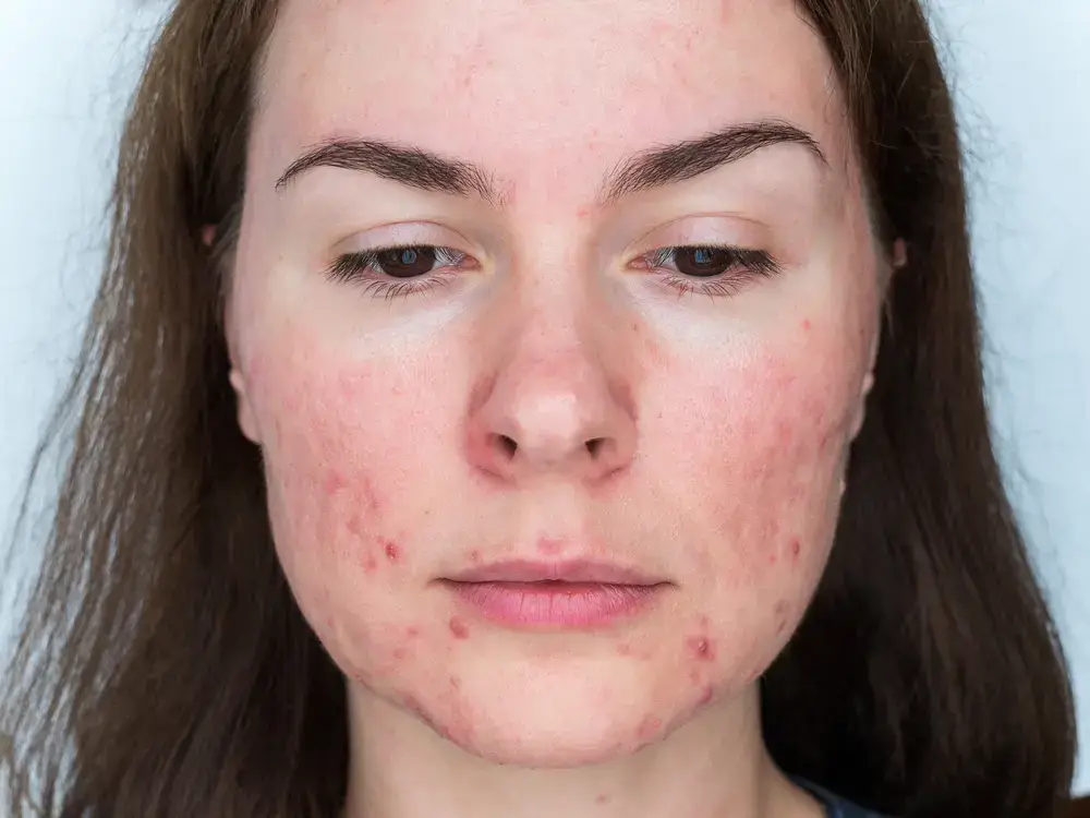 Rosacea