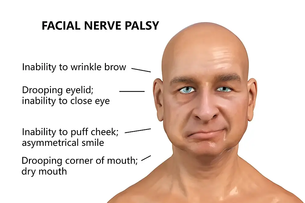 Bell’s Palsy (facial nerve paralysis)