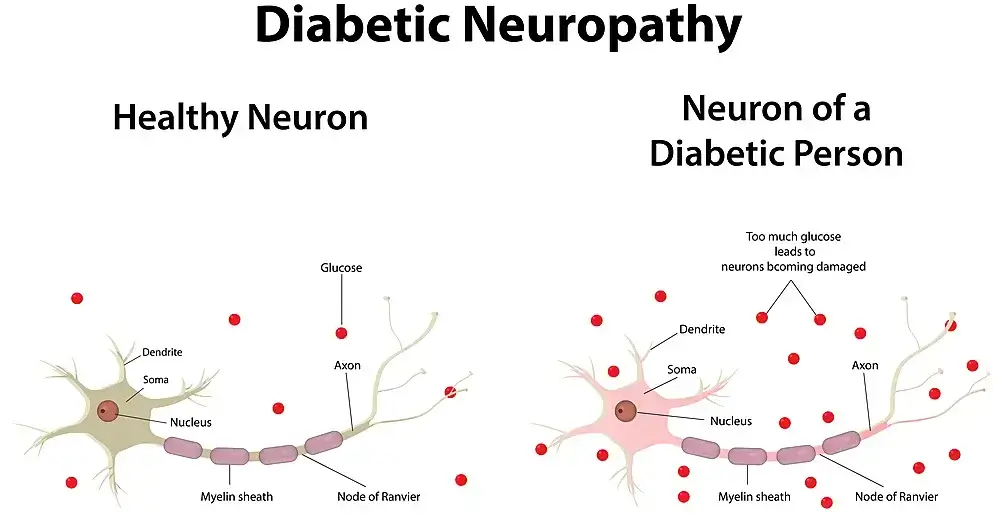 Diabetic Neuropathy