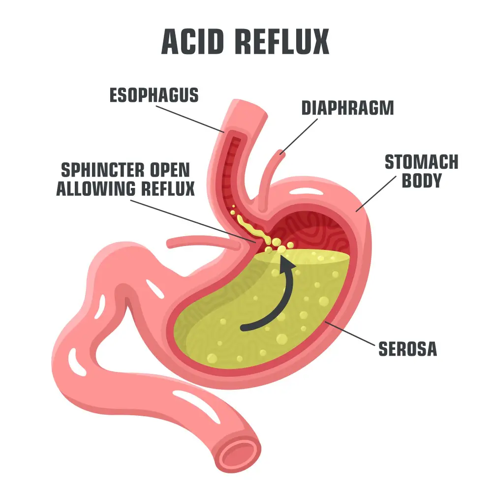 Acid Reflux