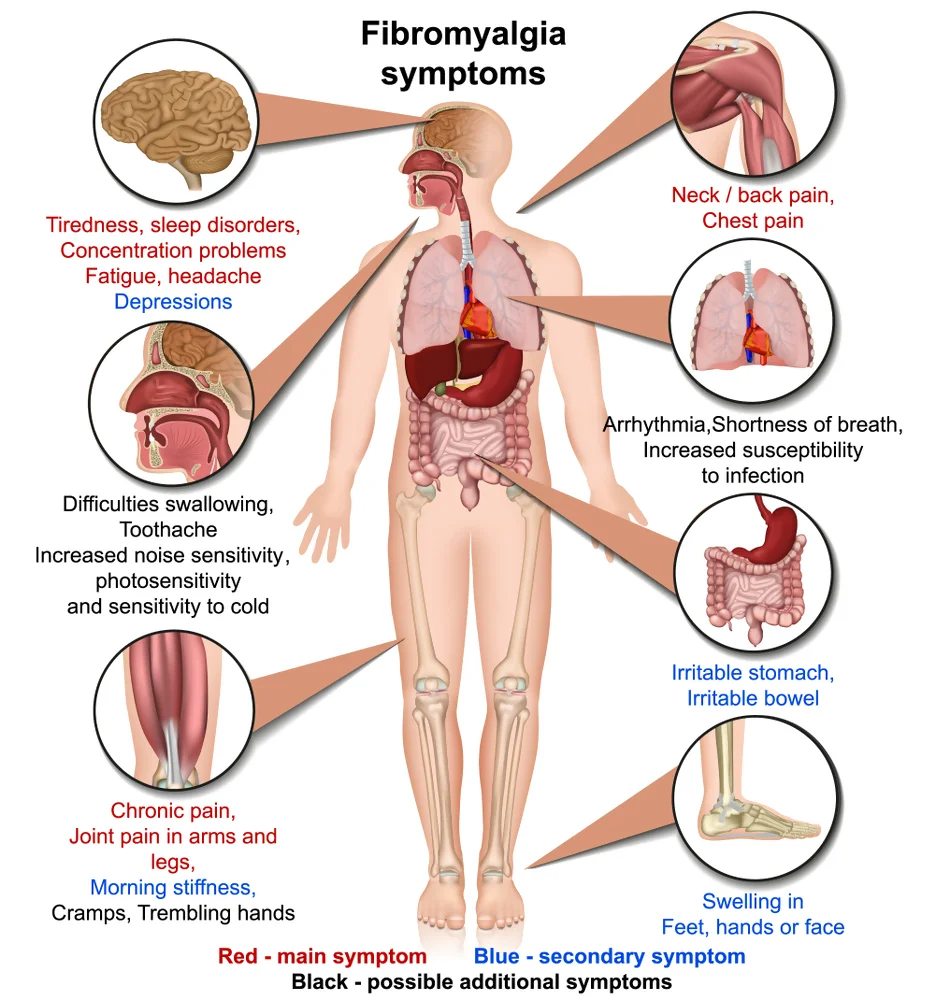 Indications of Fibromyalgia as Identified by a Naturopath