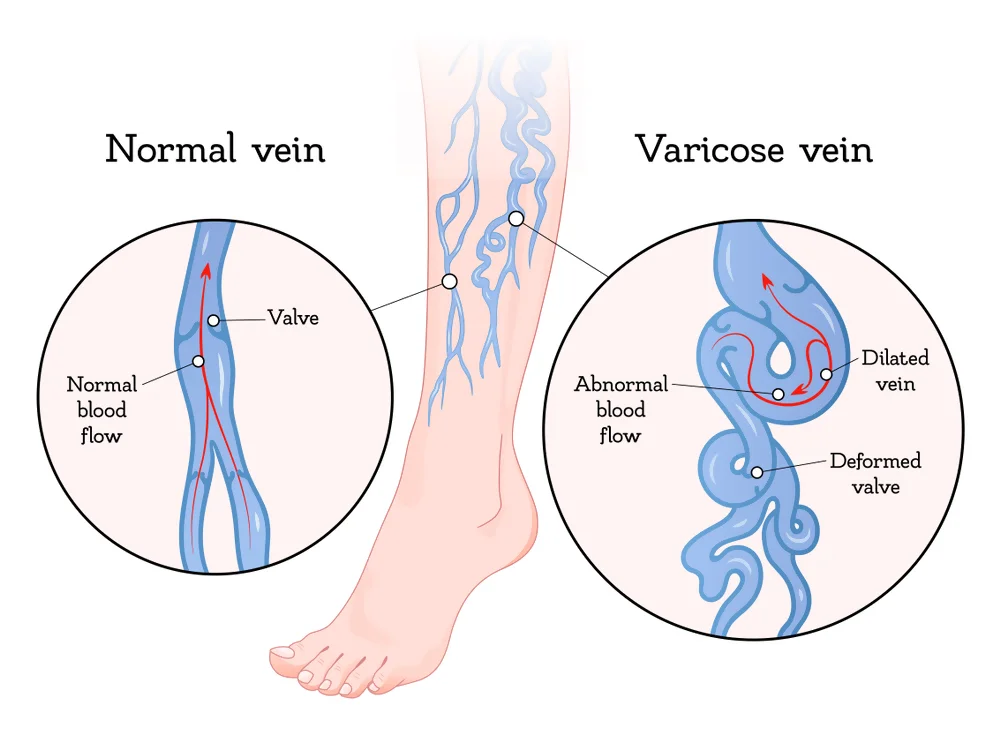 Naturopathic Insights into Varicose Veins