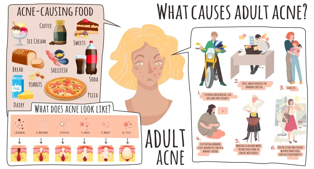 What Causes Adult Acne?