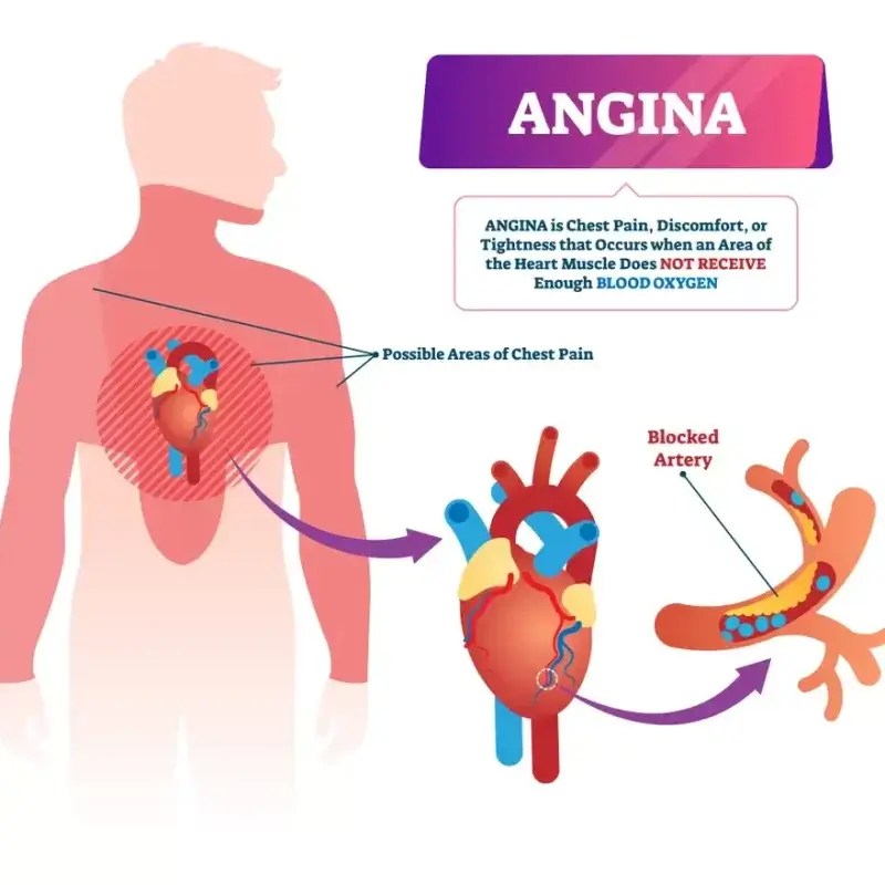 Angina