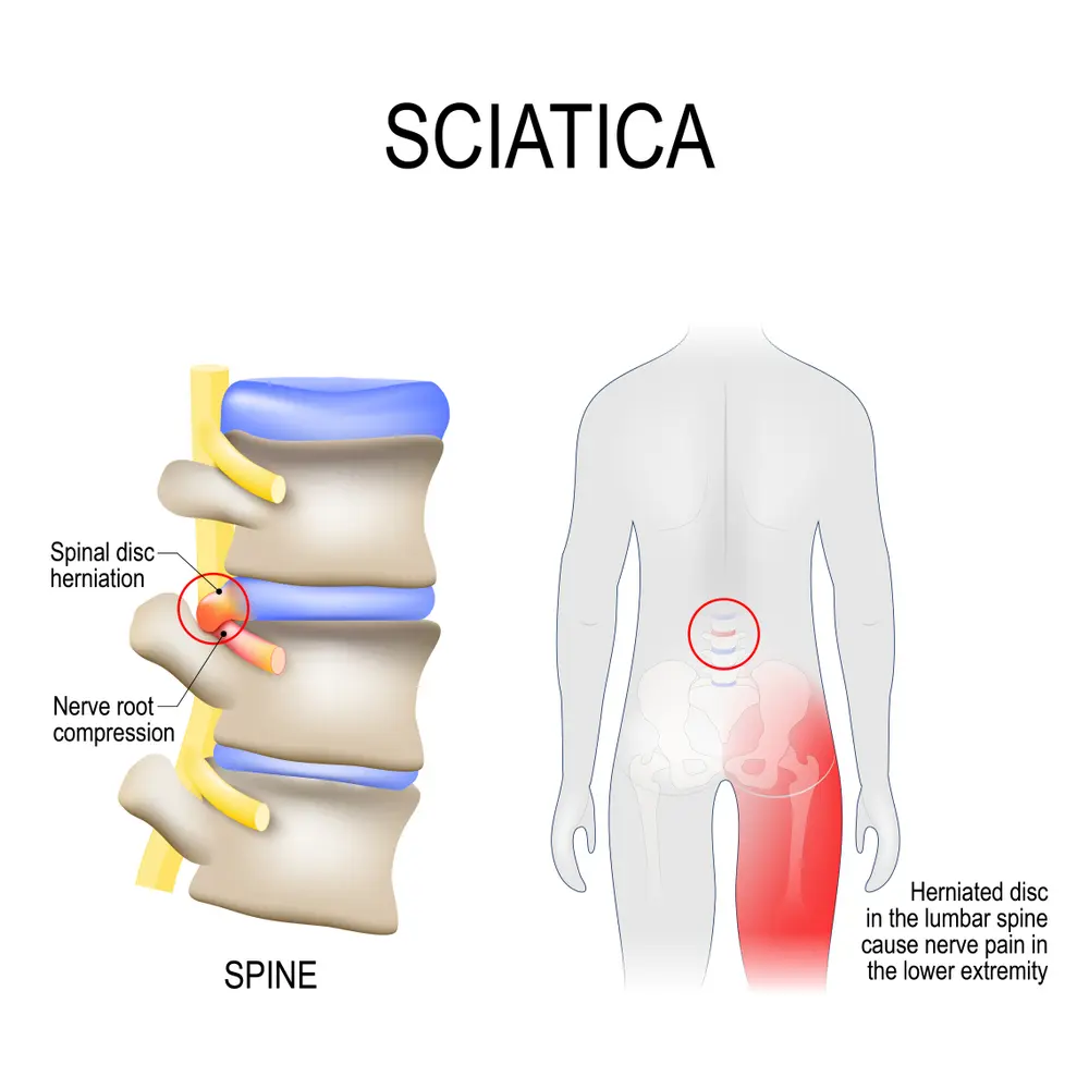 Treatment for Sciatica – Pain Management Clinic within the Naturopathic Osteopathic Practice