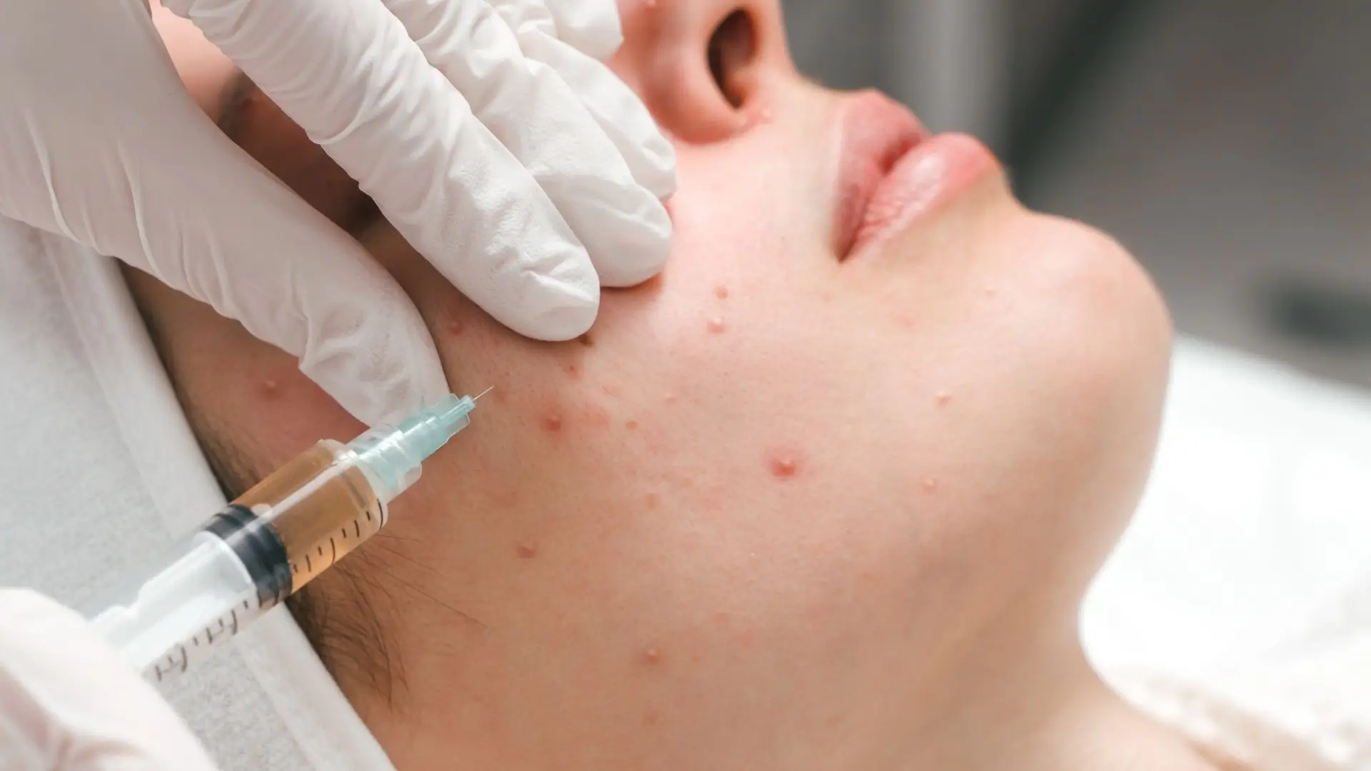 Read more about the article Acne Treatment