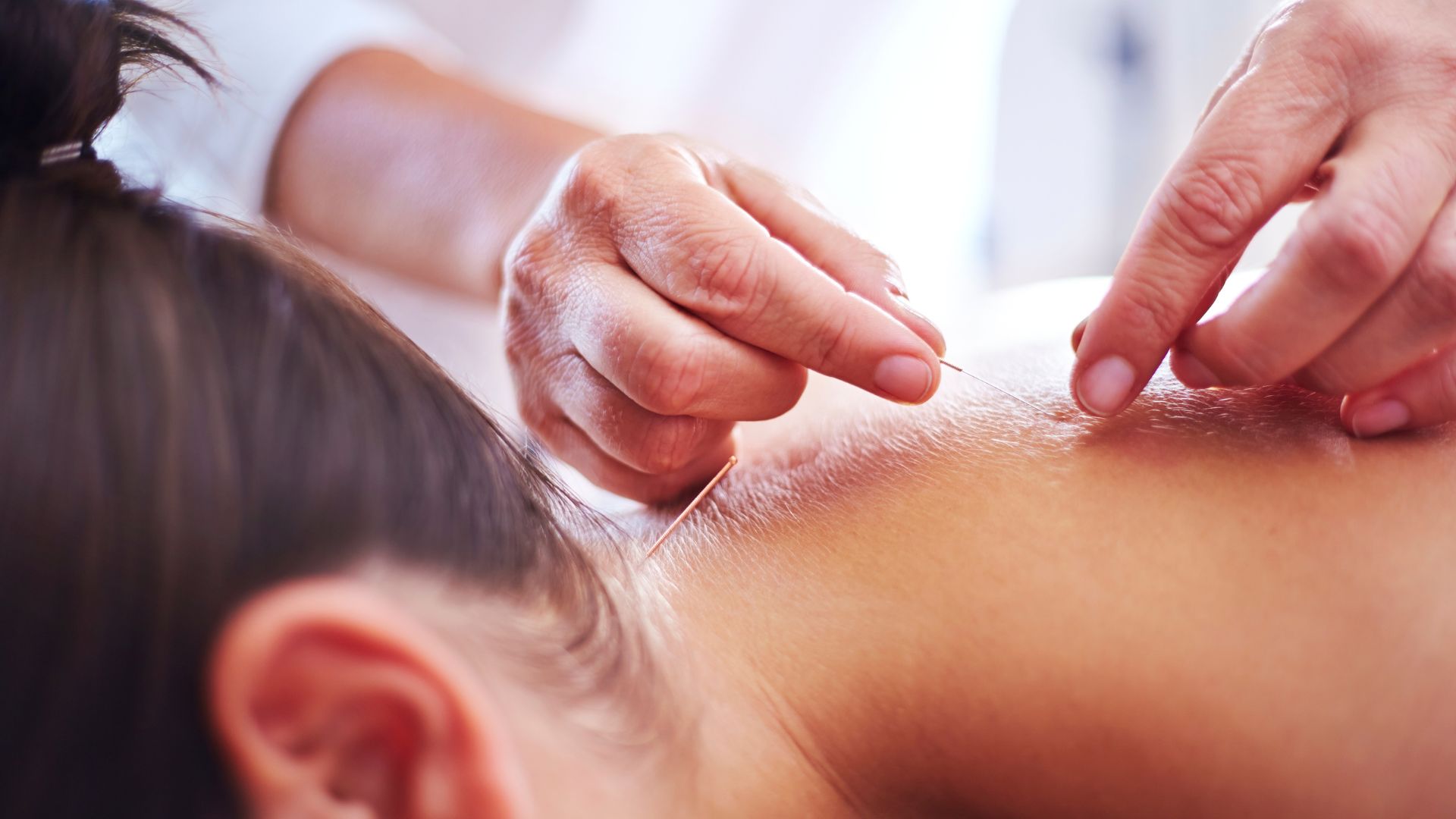 What Is Acupuncture?