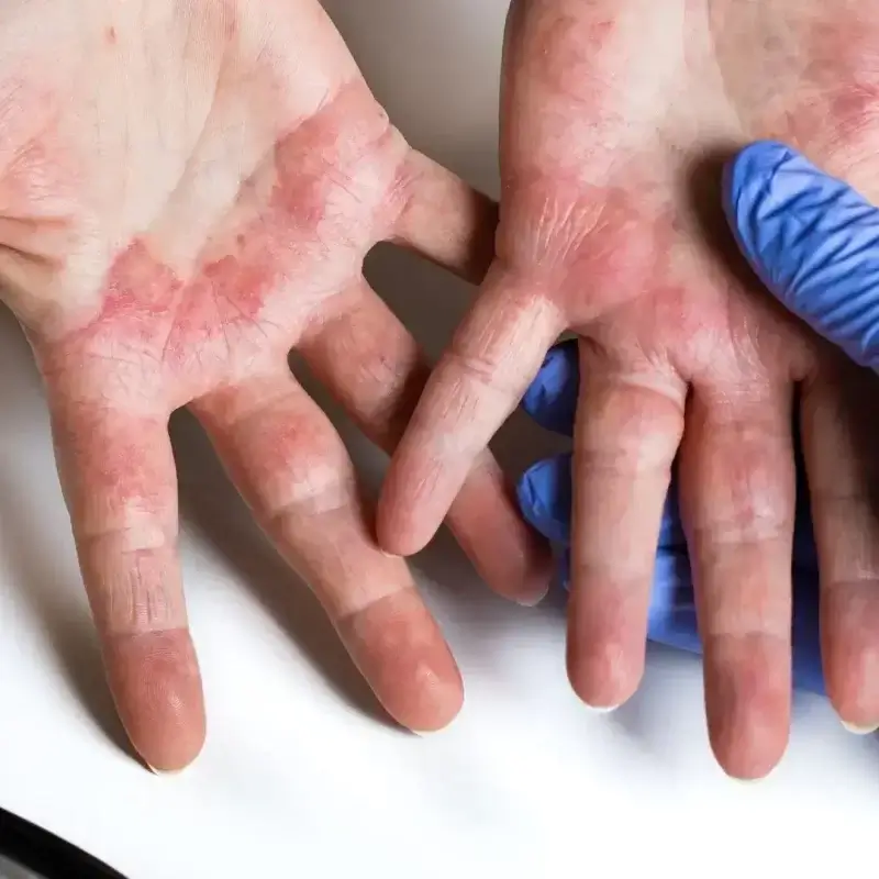 Dermatitis, Skin Allergies, Eczema