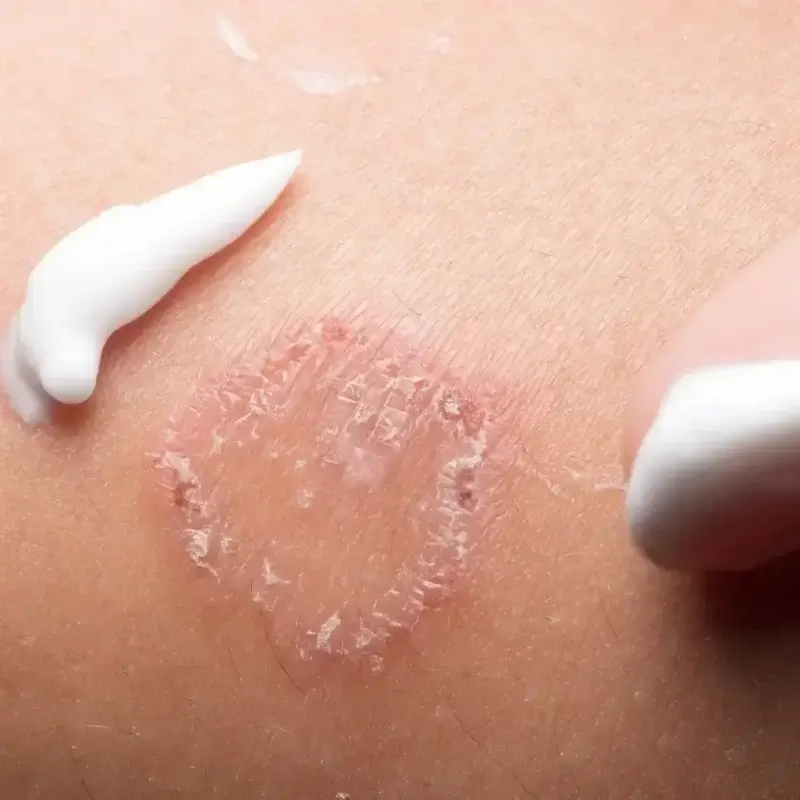 Fungal Infections – Tinea (ringworm)