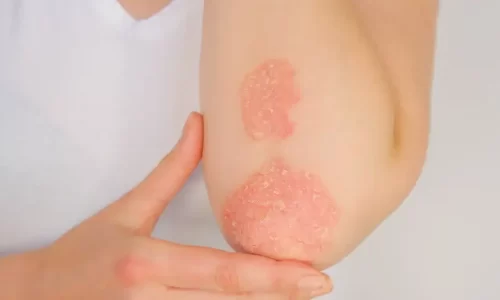 Psoriasis, Skin Disorders